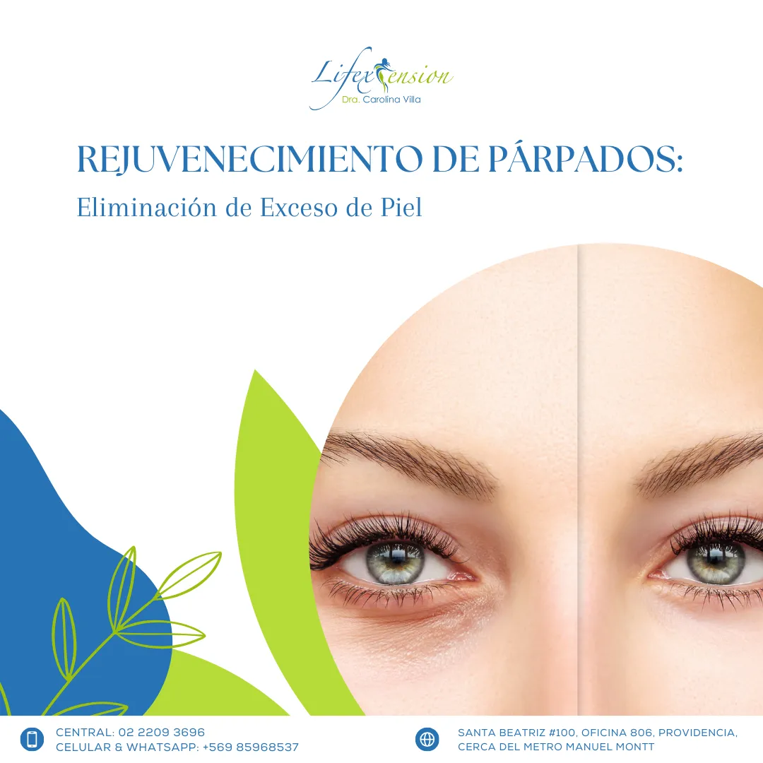 Tratamiento de  Blefaroplastia