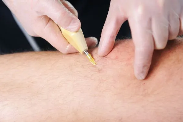 Carboxiterapia