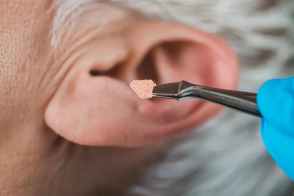 Auriculoterapia 